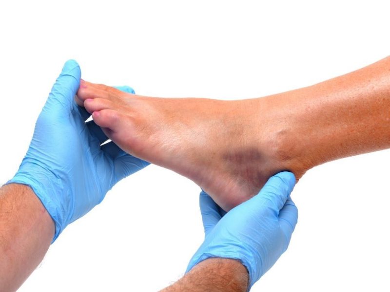 ankle sprain